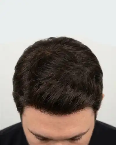 After Custom Hair Patch Service in Noida