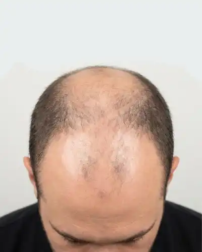 Baldness Before Hair Patch