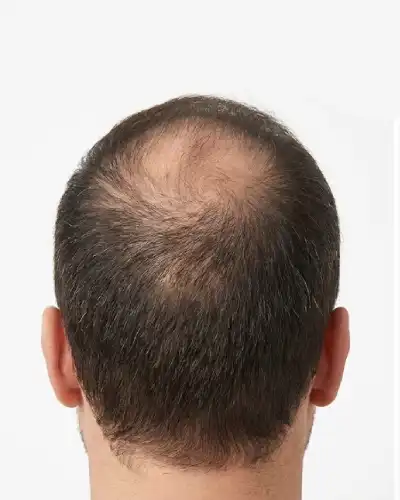 Thinning Hair Before Replacement
