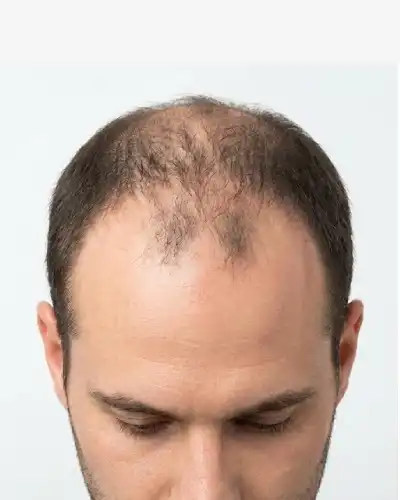 Receding Hairline Before